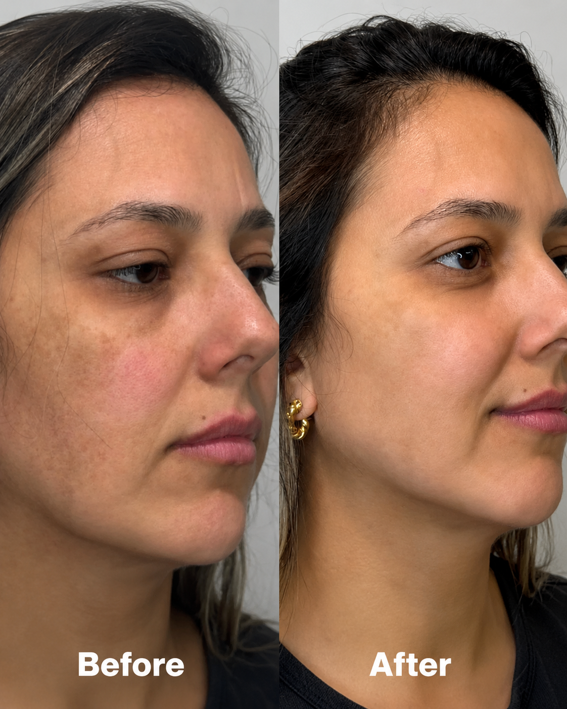 ARCFIT™ V-SHAPED JAWLINER